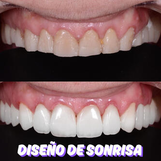 CARILLAS