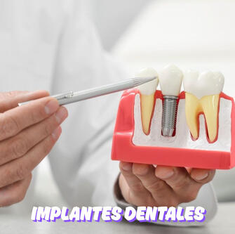 IMPLANTES