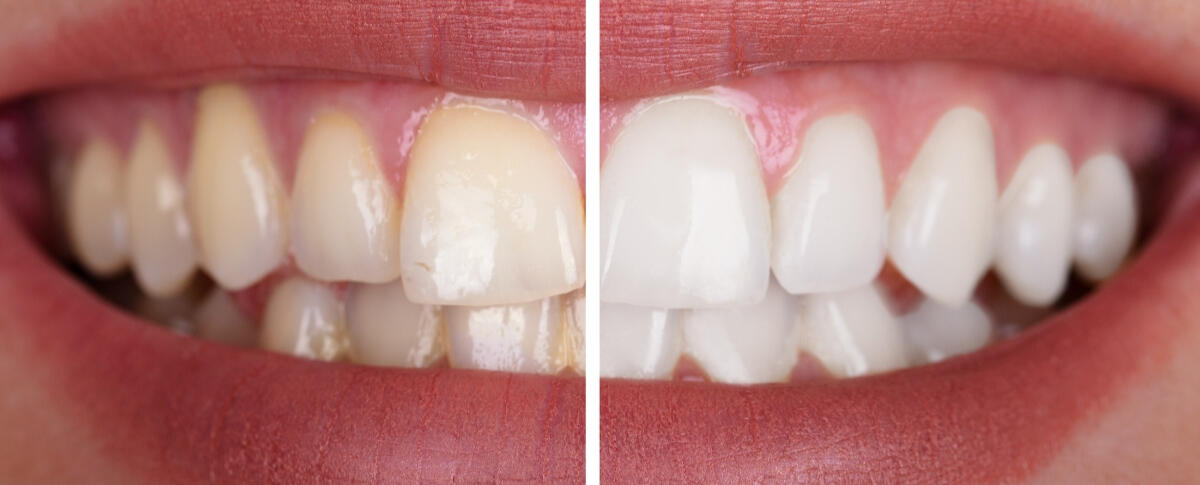 Blanqueamiento Dental